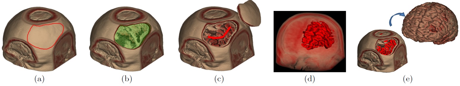 Key processes of our interactive volume manipulation framework: (a) user indicates a region for opening with a stroke, (b) a surface-based peeling operation is performed with user-specified depth, (c) the skull is removed and the user sketches seeds for segmentation, (d) the region grows, and (e) the grey and white matter are segmented and isolated.